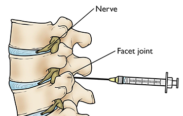 Spine-Peripheral